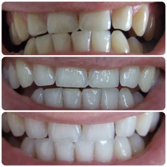 Домашнее отбеливание зубов White Light представляет собой один из оптимальных пр. . фото 5