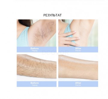 Фотоэпилятор Intense Pulsed Light IPL с дисплеем 900 400 вспышек Голубой. . фото 7 Фотоэпилятор 900 400 вспышек IPL
Как часто пользоватся фотоэпилятором:
Результ. . фото 7