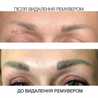Видалення татуажу та тату лазер/ремувер. Київ. фото 1 Видалення татуажу та тату лазер/ремувер. Київ. фото 1