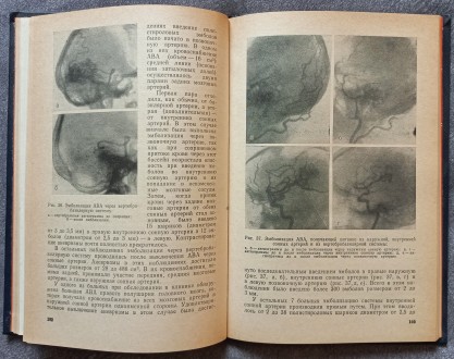 Внутрисосудистая нейрохирургия. В.А. Хилько, Ю.Н. Зубков. М.: Медицина, 1982. - . . фото 6