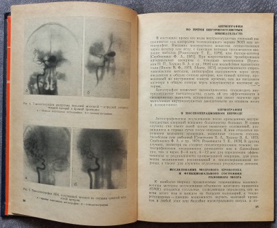 Внутрисосудистая нейрохирургия. В.А. Хилько, Ю.Н. Зубков. М.: Медицина, 1982. - . . фото 4